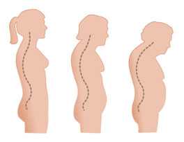 _immagini_fratture-vertebrali.jpg